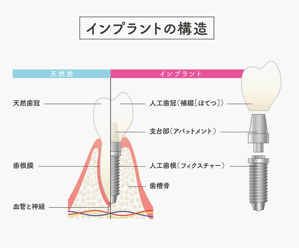 インプラントの3つのパーツ構造図